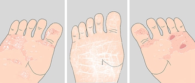脚气冒的水泡怎么办